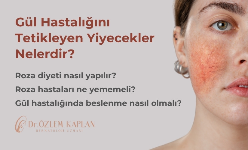 Gül Hastalığını Tetikleyen Yiyecekler, Roza Hastaları Ne Yememeli ve Roza Diyeti Kılavuzu Samsun