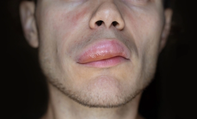 Herediter anjioödem (HAE): Genetik anjioödem nedir? Tedavisi Samsun