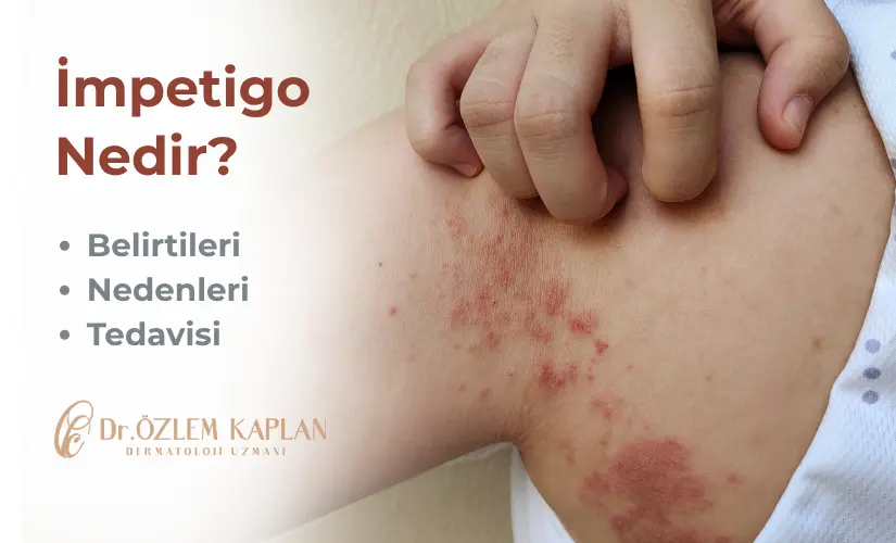 İmpetigo Nedir? Belirtileri ve Samsun İmpetigo Tedavisi | Dermatoloji Uzmanı Dr. Özlem Kaplan