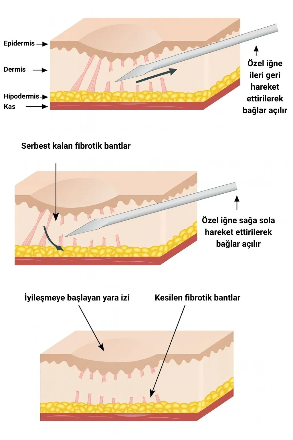 Subsizyon ile Akne ve Skar İzi Tedavisi Samsun